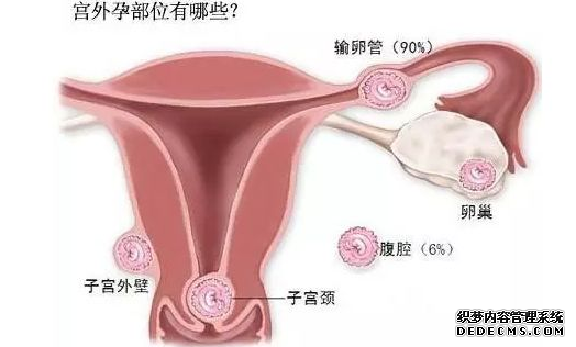 马鞍山“宫外孕”是什么样的一种病?它有那么危险吗?
