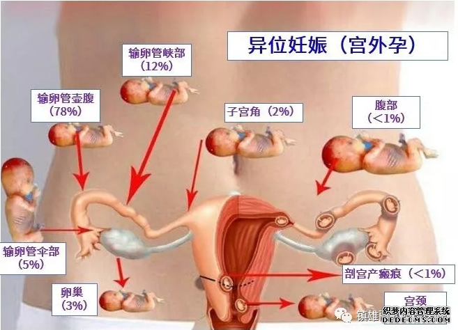 马鞍山宫外孕—那安错家落错户的“种子”